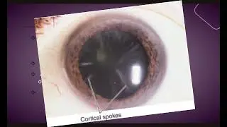 Classification of Cataract | Ophthalmology | Eye Concepts Medical Understand this topic easily 