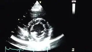 Parasternale kurze Achse in H&ouml;he der Papillarmuskeln (PSAX-view  papillary muscle level)
