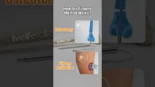How the Fitbone method works? #limblengthening #fitbone #fitboneturkey #heightsurgery #shorts