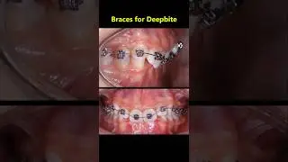 Braces fix deepbite also fix gummy smile #braces #orthodontist #dentist #dental #orthodontics
