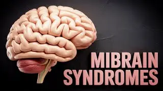 Localizing the Strokes - Part IV: Midbrain syndromes