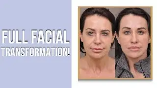 Full Face Transformation from Dr  Ben Talei of Beverly Hills Center for Plastic Surgery