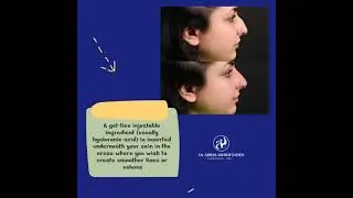 nonsurgical rhinoplasty , Nose Filler Injection nonsurgical #shorts #rhinoplasty