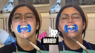 BRACES OFF!! 🥰