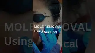 Mole Removal By Using Surgical CO2 Laser | @DrRinkyKapoor  | @TheEstheticClinics