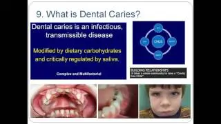 Oral Health Risk Assessment  Improving Oral Health in Underserved Populations