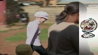 Black people with albinism face constant rejection in a hostile society