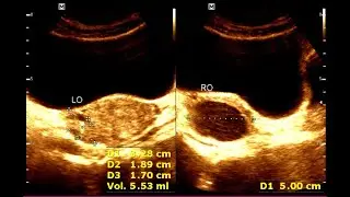 Right Adnexal Pain in a Young Woman | Hemorrhagic Ovarian Cyst Ultrasound