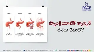 ప్యాంక్రియాటిక్ క్యాన్సర్ దశలు ఏమిటి? | Stages of Pancreatic Cancer #pancreaticcancer
