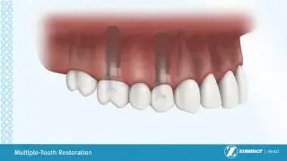 Replacing Multiple Missing Teeth With Dental Implants