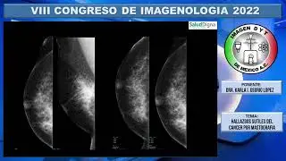 HALLAZGOS SUTILES DEL CANCER DE MAMA POR MASTOGRAFIA.   DRA. KARLA I. OSORIO LOPEZ.