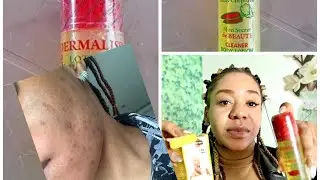 Dermalis lotion a life saver for acne, blackheads and darks pots .The truth no one tells you about.
