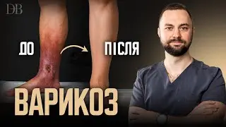 Лікування варикозу лазером: чи повернеться хвороба?