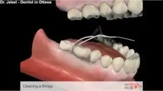 Preventive - Cleaning A Bridge - Dentists In Ottawa