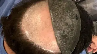 NEW ANTIMICROBIAL HAIR SYSTEM | LAVIVID