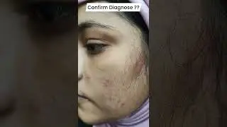 Tinea Faciei Treatment By...Dr. Ahsan Ahmad Skin Care Clinic Call/WhatsApp +917417928805