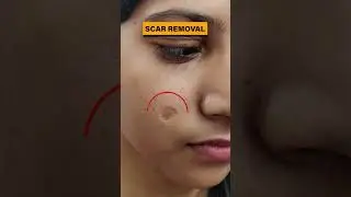 Scar Removal Treatment in Delhi | Scar removal results before and after #scar #scarremoval #scars