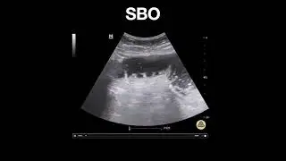 Small Bowel Obstruction