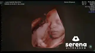 Bebê Sorrindo na Barriga no Ultrassom 5D