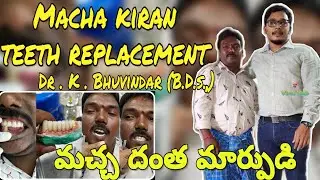 Macha Kiran Teeth Replacement | Dr. K. Bhuvindar, B.D.S.,