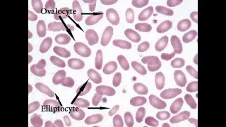 Morphology of Elliptocyte (Ovalocyte) Red Blood Cell ; Definition, Structure, Features