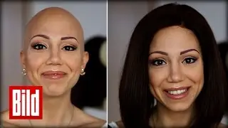 Haarausfall und Glatze: Aline ist am ganzen Körper kahl