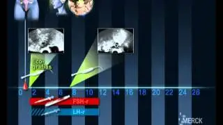 Estimulación ovárica : protocolo antagonistas