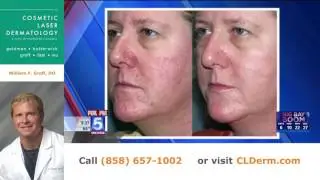 Treatments for Rosacea