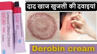 Derobin cream  fungal infection ka asan Ilaj| Psoriasis Cream के Uses और Side Effects.