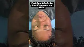 Watch These Dehydration Lines Soften After One Facial 💧