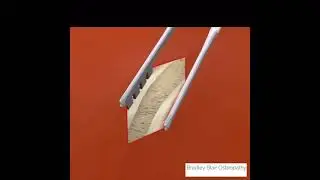 Anterior Iliac Crest Tricortical Bone Graft