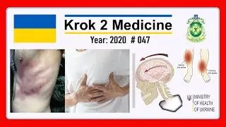 [ Krok 2 Medicine ] Year: 2020 - 047 (Ministry of Public Health of Ukraine)