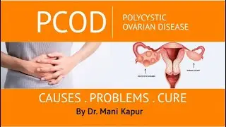 Polycystic Ovarian Disease | PCOD - Prevention & Treatment | Dr. Mani Kapur | Star Imaging