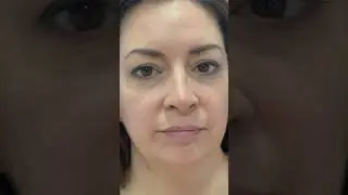 Rinoplastia cerrada antes y despu&eacute;s
