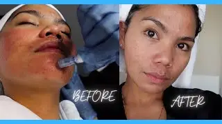 MICRONEEDLING RESULTS IN 6 DAYS!  MY FIRST MICRONEEDLING EXPERIENCE FOR ACNE SCARS | Janenelodie
