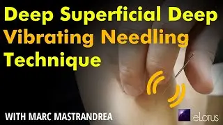Deep Superficial Deep (DSD) Vibrating Needling Technique by Marc Mastrandrea