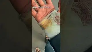 Pain doesnt ￼ distroy you.🩸/ marte marte bacha bhai 🤕⚰️#accidenttruck #bikecrashing #crash #viral