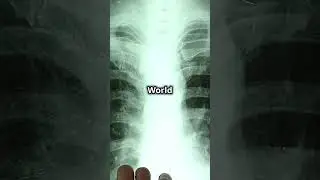 🌍 World Cancer Day 2025 - Why It Matters 🎗️