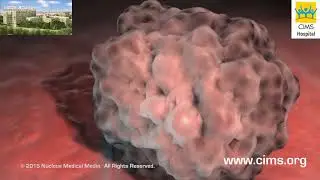 Cystoscopy (Hindi) - CIMS Hospital