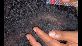 Asmr/ scratching flaky dandruff and dirt. Scalp check and gum chewing