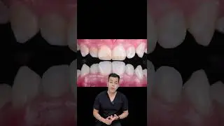 🦷 White Spot Lesions on Teeth | Early Signs of Tooth Decay | Dr. Rajat Sachdeva | Delhi Dentist