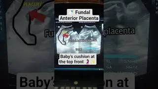 Fundal Anterior Placenta on Ultrasound 🍼 | Pregnancy Scan View #ultrasound #baby