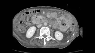 Metastatic melanoma on CT