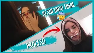 RESULTADO DE MI OPERACIÓN 🤕 (+ RECUPERACIÓN) Kimberly Loaiza