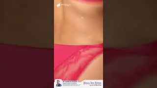 Bra Roll Liposuction Before/After