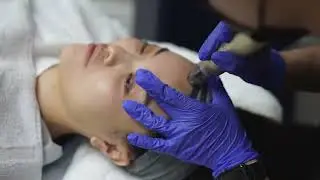 Sylfirm X RF Microneedling - Medical Aesthetics Treatment Showcase
