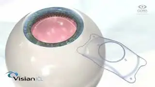ICL Eye Procedure: A Reversible Vision Correction Option
