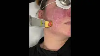 Vascular laser 1