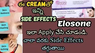 Elosone-HT Cream side effectsని ఇలా తగ్గించుకోండి| Skin Redness, Itching & Skin Peeling|Boon Passion