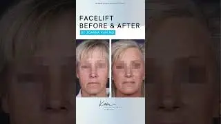 Facelift at her early 60&rsquo;s by. Dr. Kam 🌟